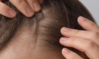 Jak se zbavit lupů ve vlasech? Účinné rady a tipy